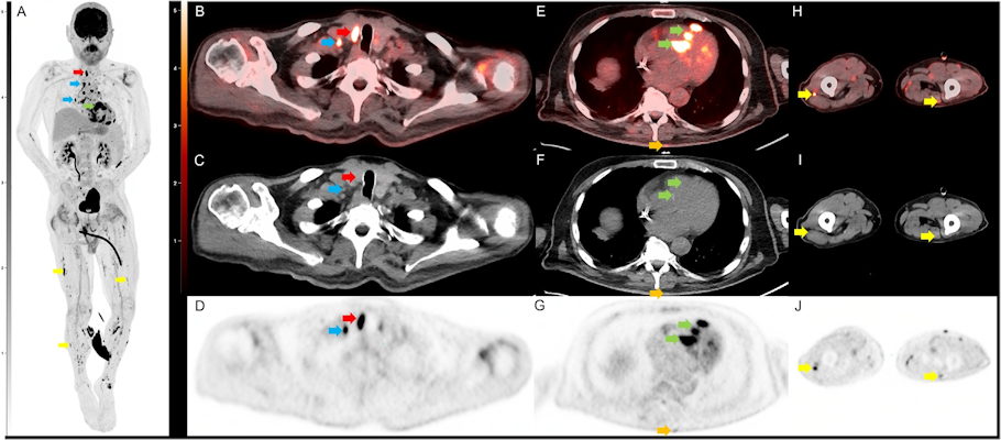 Selected images from the initial FDG PET CT